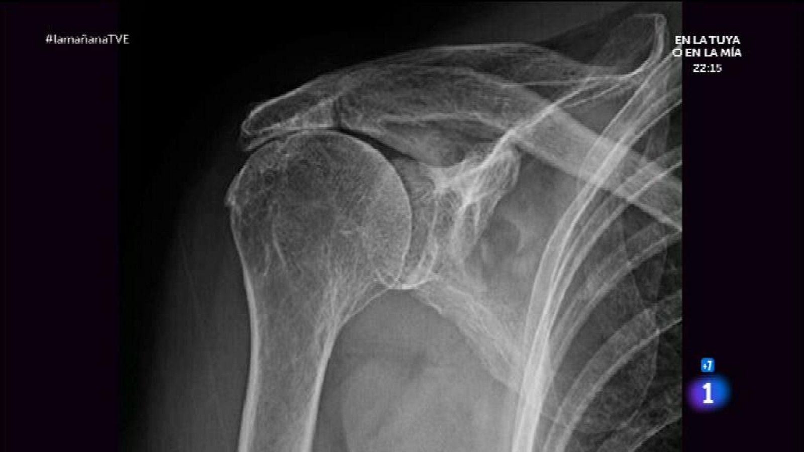 Dolor de hombro ¿cómo aliviarlo?