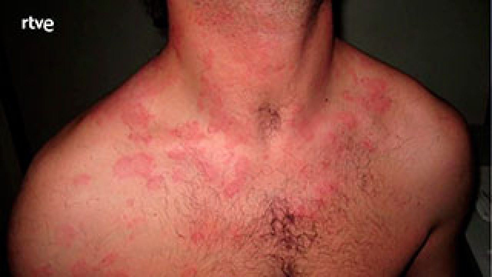  5 síntomas claros de alergia