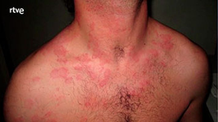  - 5 síntomas claros de alergia