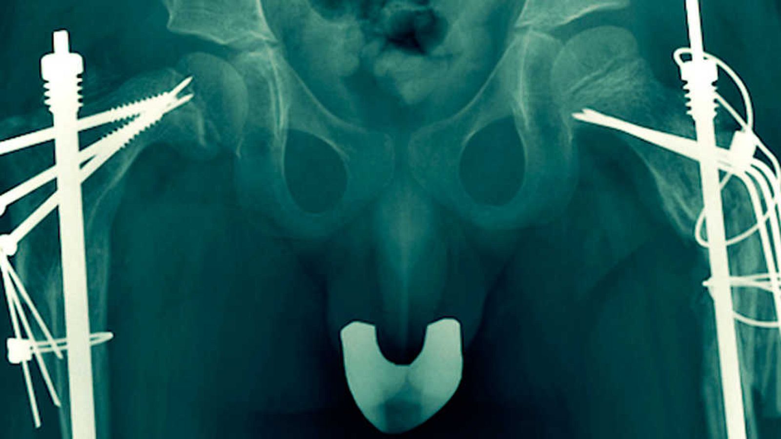 Documentos TV - Frágil, camino de cristal - ver ahora