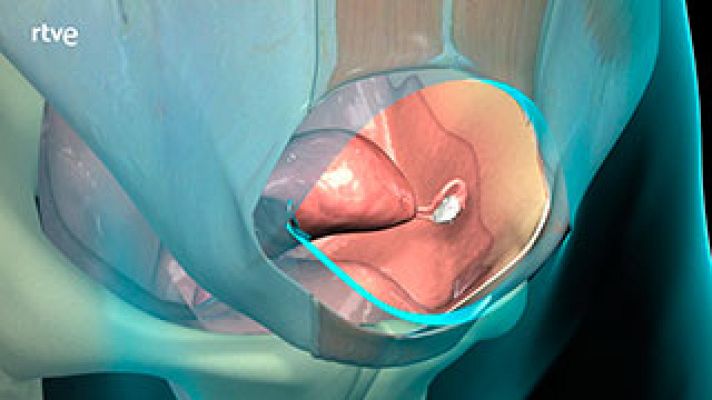  - ¿En qué consiste una histerectomía?