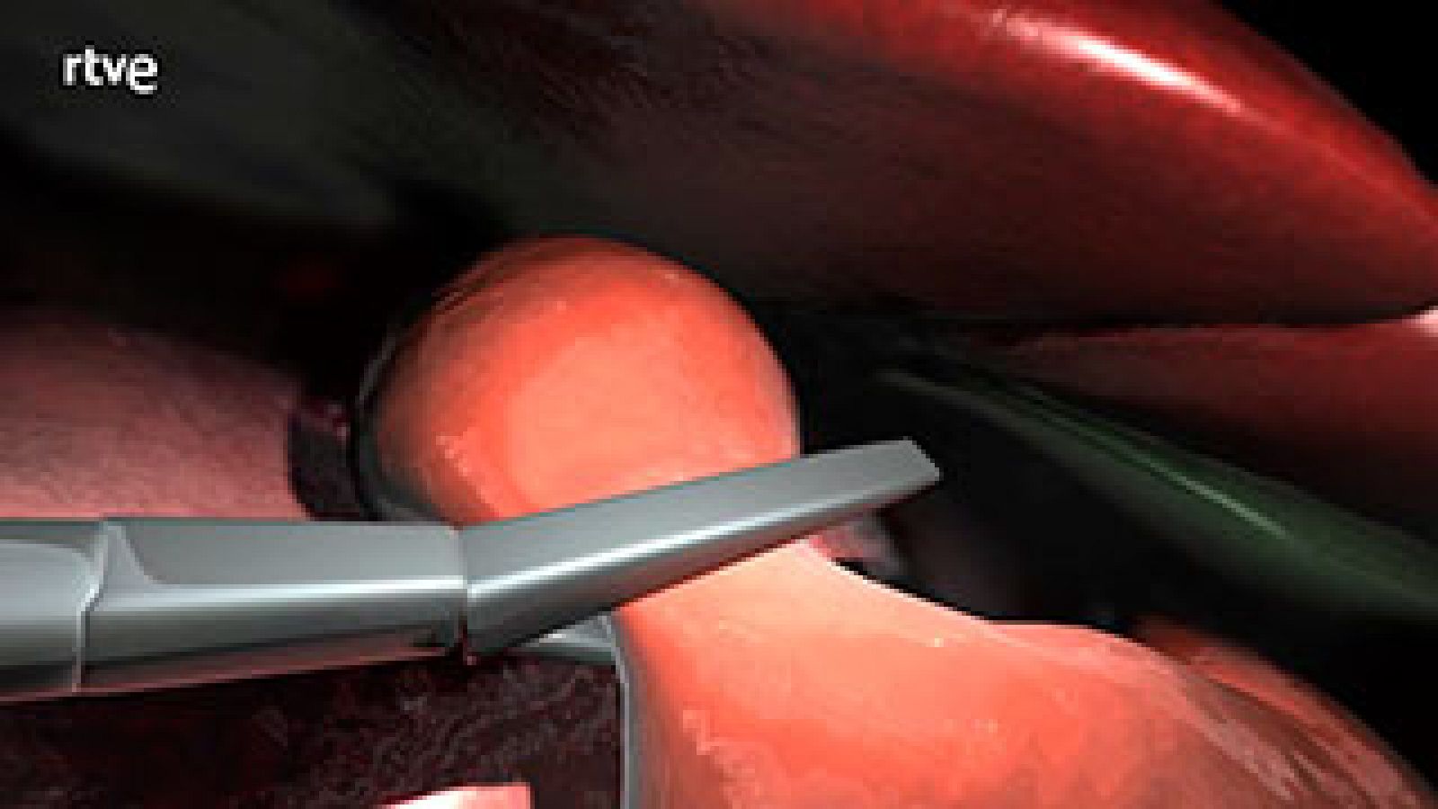  Operación para adelgazar cuando hay obesidad mórbida