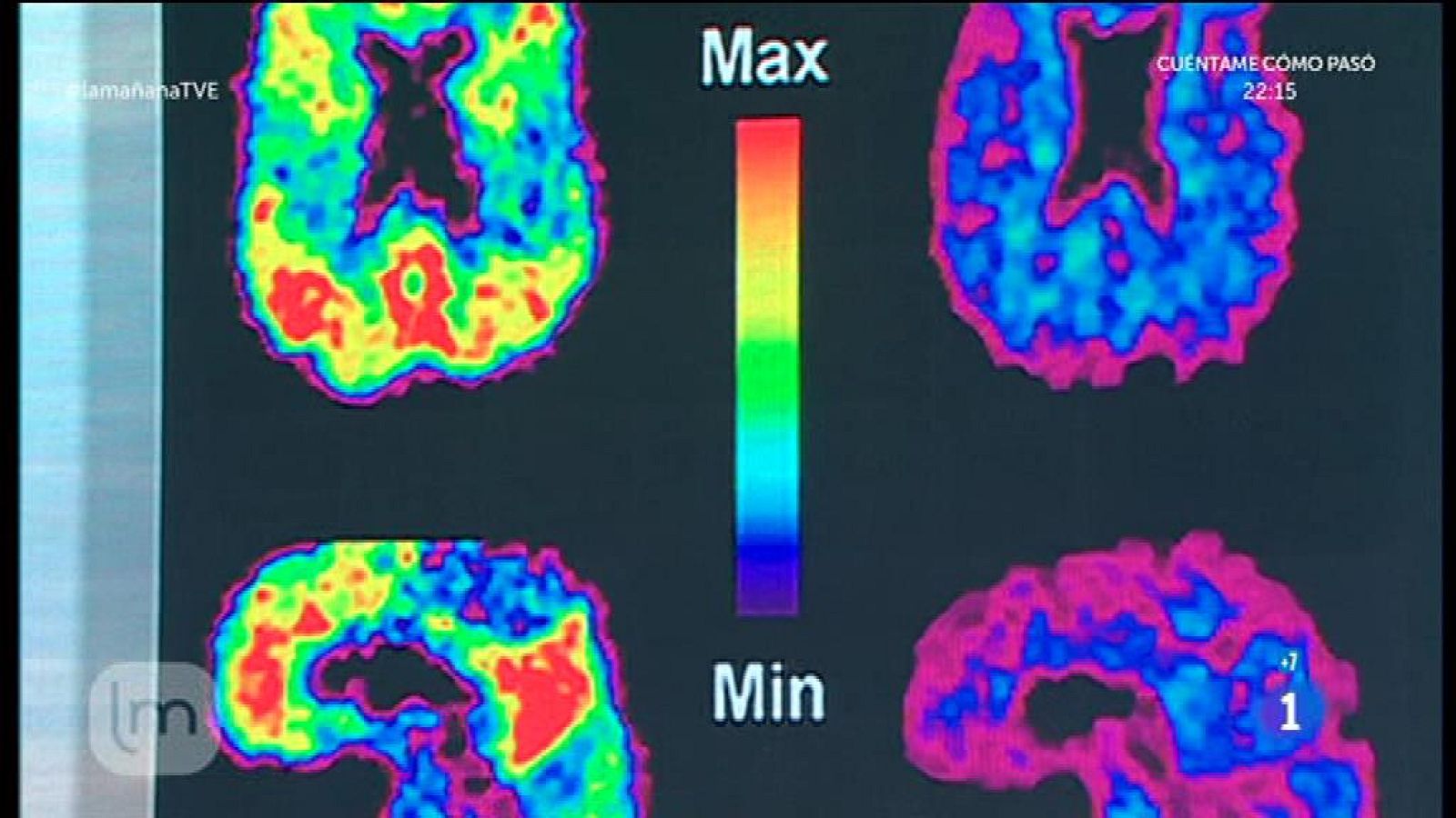 Novedades en demencia