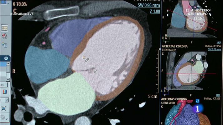 La mañana - Herencia y predisposición en el corazón