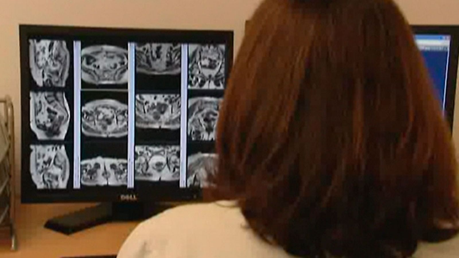 Uno de cada veinte españoles padecerá cáncer de colón a lo largo de su vida