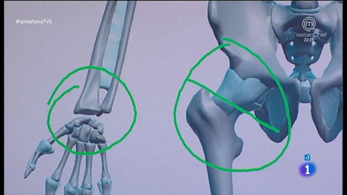 La mañana - Cadera y masa ósea