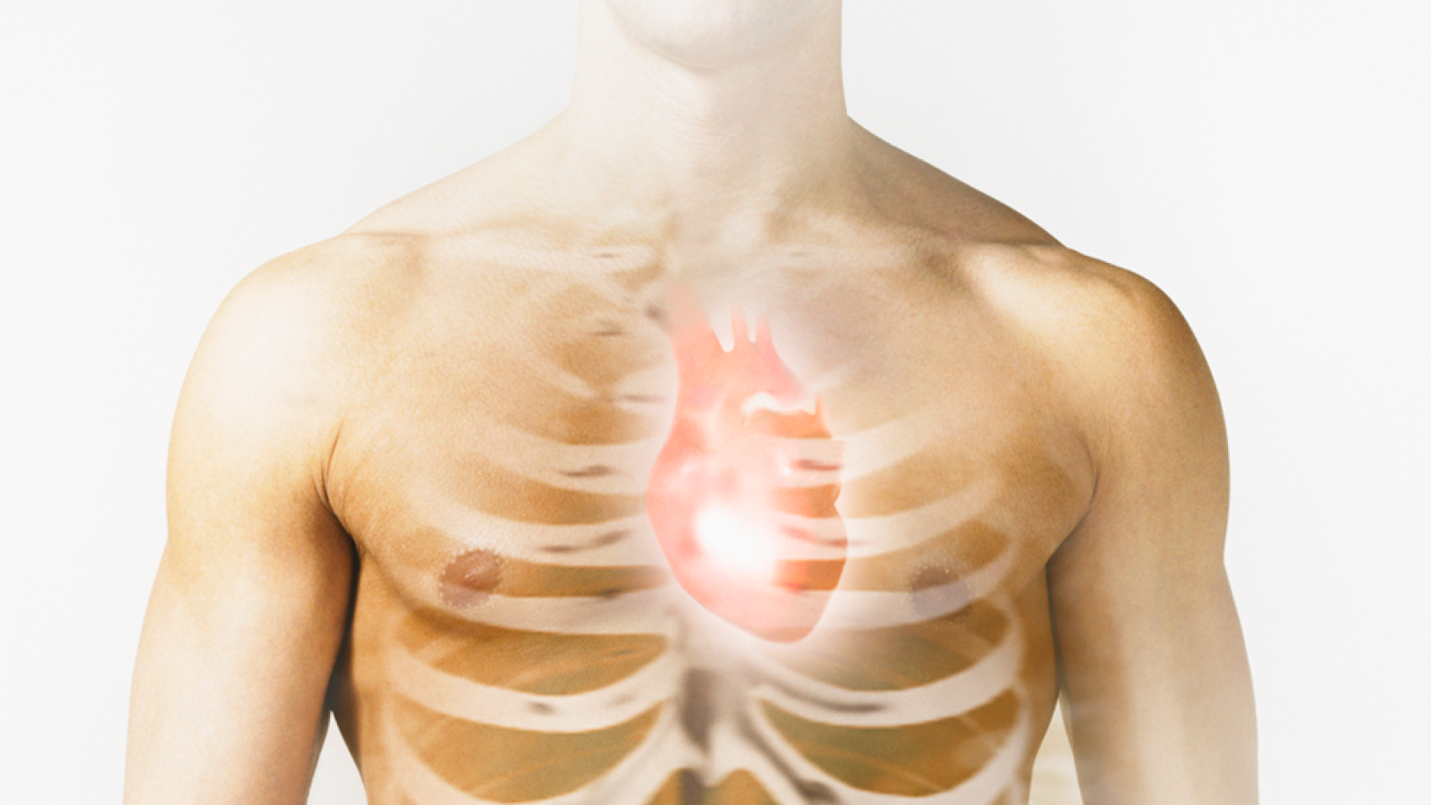 El aneurisma de la aorta