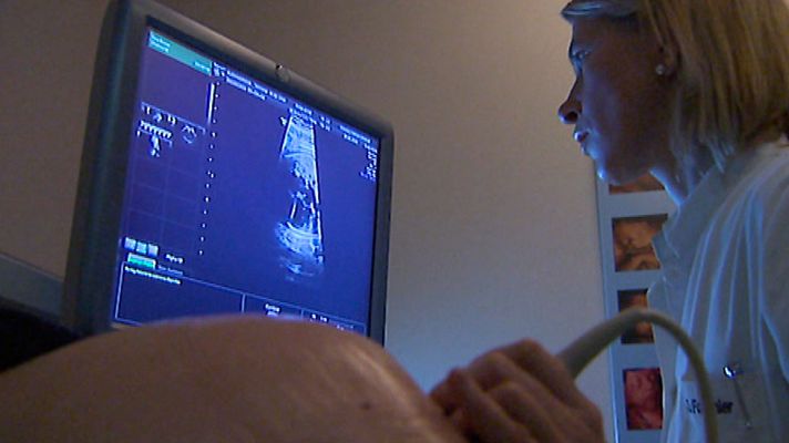 Telediario 1 - Los científicos aún no han podido precisar la relación causa-efecto entre el Zika y la microcefalia