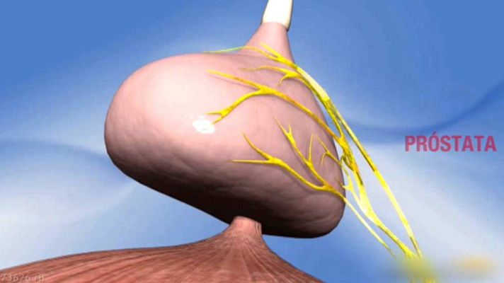Telediario 1 - Se celebra el Día Mundial del cáncer de próstata, el tumor más frecuente entre los hombres