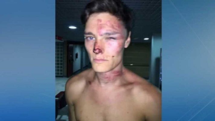 Telediario 1 - Dos turistas británicos denuncian haber recibido una paliza de los vigilantes de un hotel en Magaluf