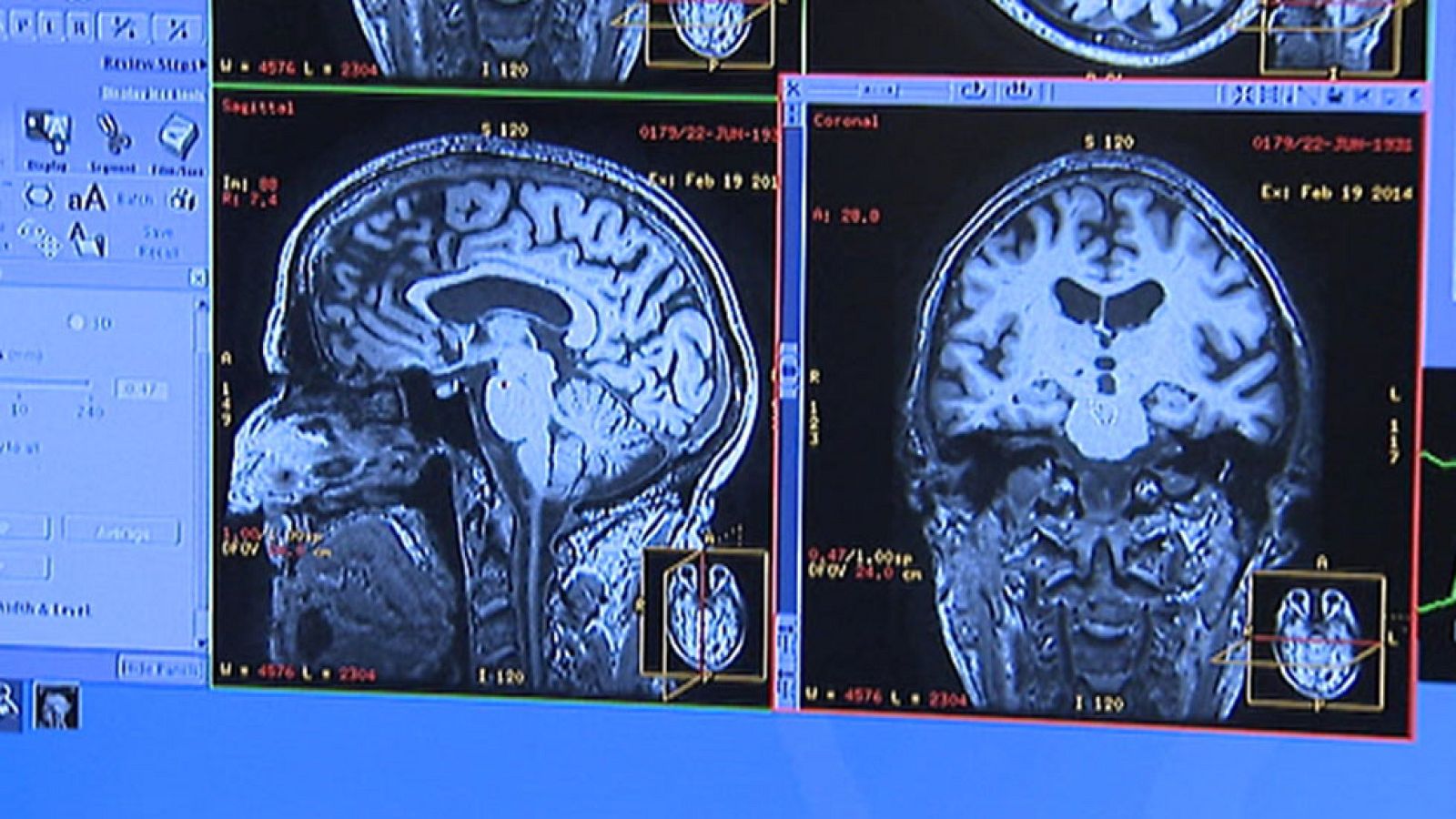 La preocupación principal de los enfermos de esquizofrenia es quedarse solos y ser rechazado por la sociedad
