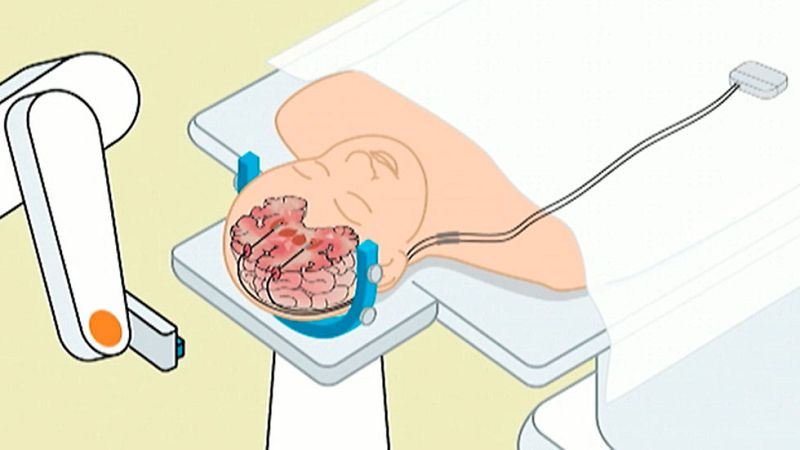Dos hospitales de Barcelona han conseguido hacer un implante  pionero en Europa para  mejorar los efectos de la  enfermedad de distonía