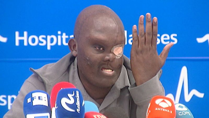 Mike procedente de Kenia es operado de un tumor del tamaño de su cabeza en España para ganar calidad y años de vida