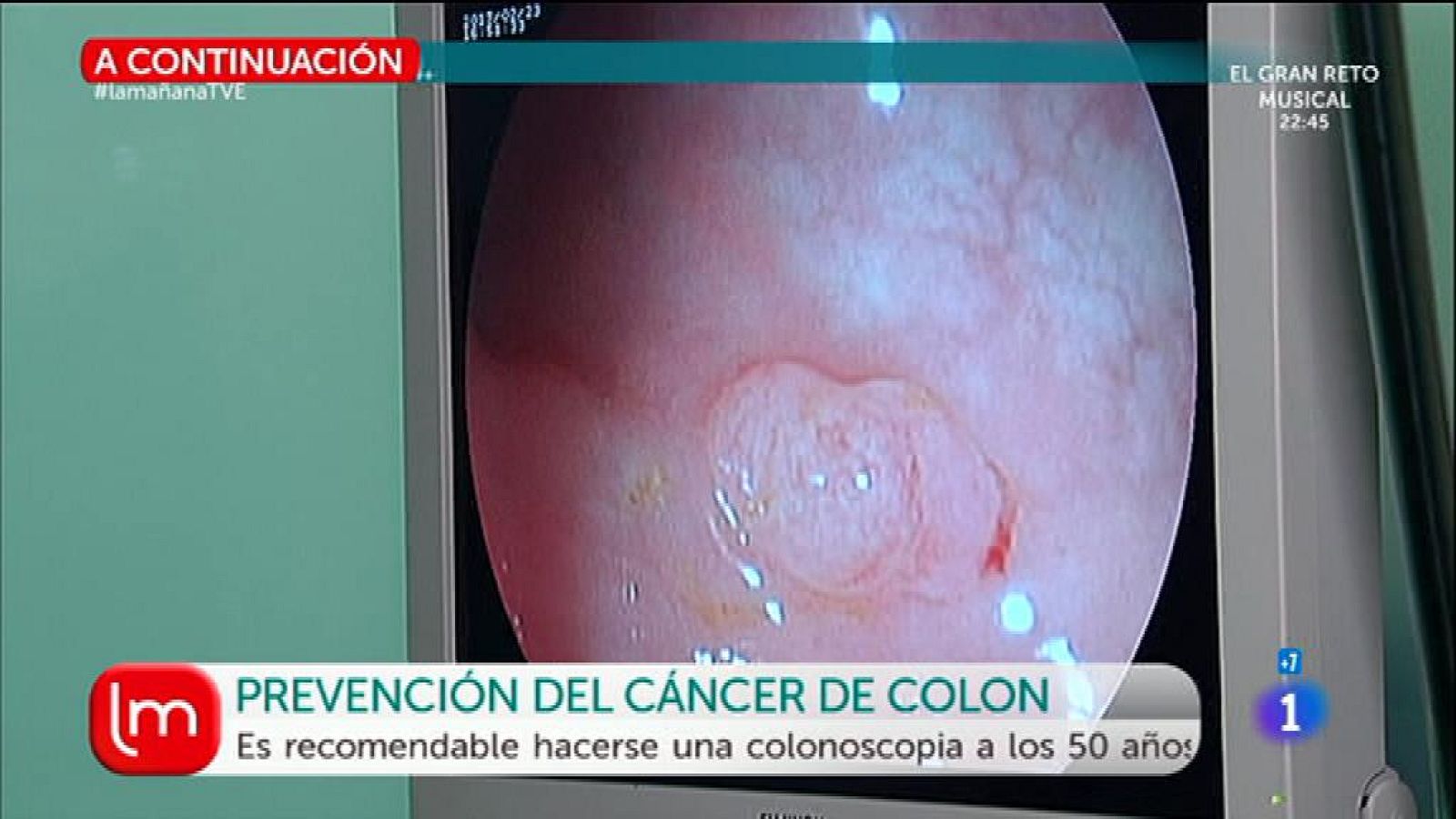 Cáncer de colon