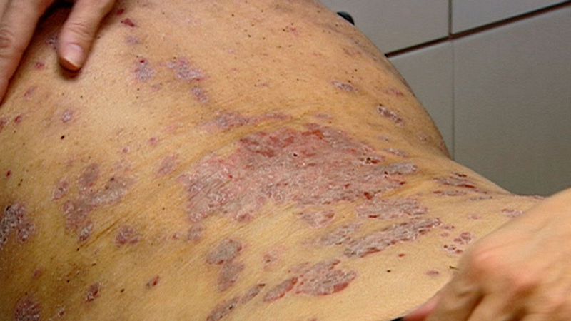 Un proyecto de realidad virtual para derribar prejuicios sobre la psoriasis