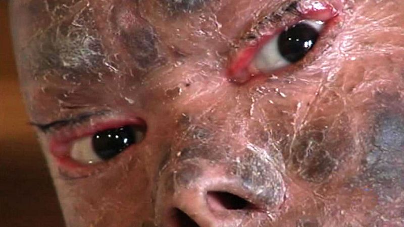 En  Málaga está siendo tratada una chica india de una extraña enfermedad genética que le hace mudar la piel cada 45 días