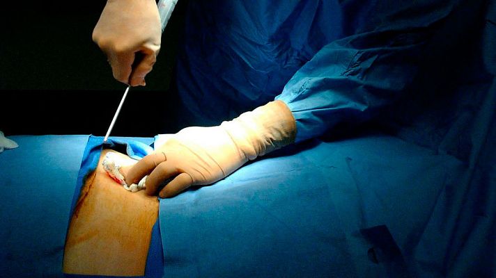 Telediario 1 - La probabilidad de encontrar un donante de médula ósea en España sube al 90%