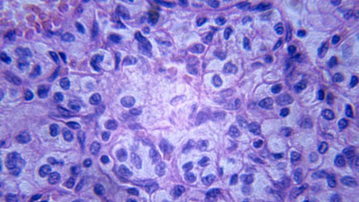 Telediario 1 - Así continúa la investigación en la lucha contra el cáncer