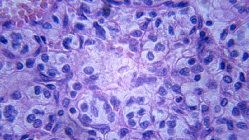 Así continúa la investigación en la lucha contra el cáncer