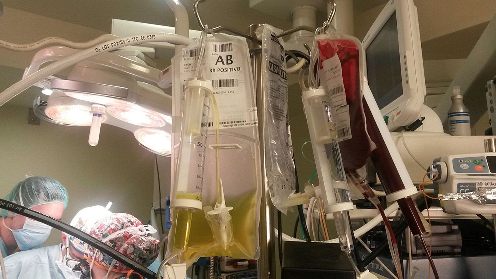 Primer trasplante de corazón con sangre incompatible a una bebé de cinco meses