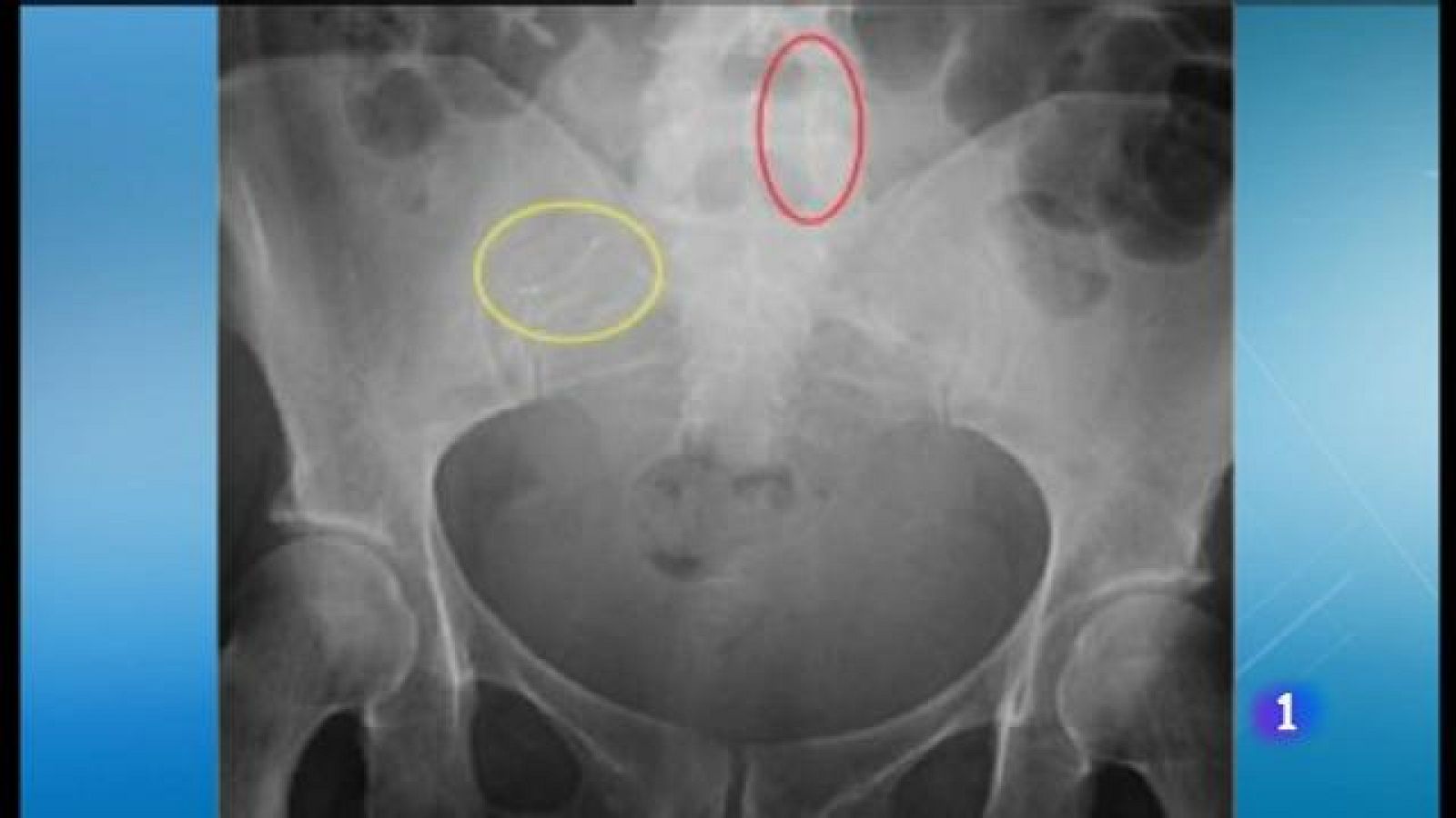 Demanda col·lectiva per l'Essure