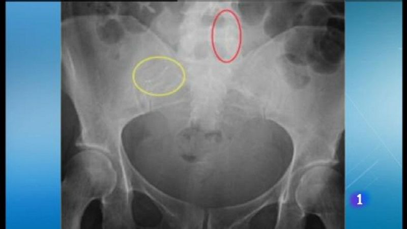 Demanda col·lectiva per l'Essure