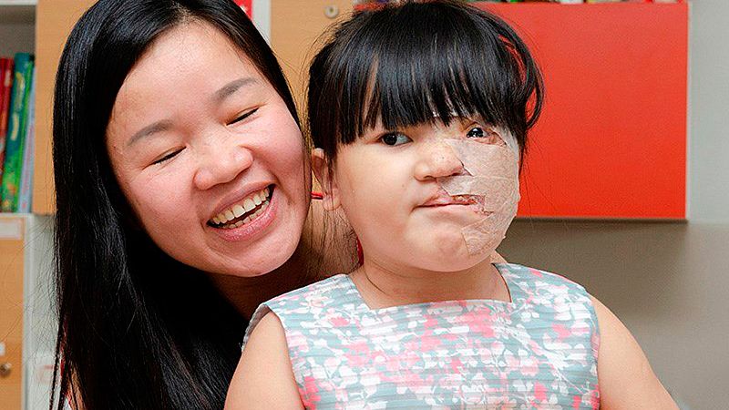El Hospital Gregorio Marañón devuelve el rostro a una niña vietnamita que sufría un tumor gigante