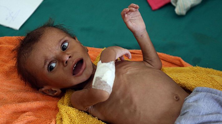 Telediario 1 - Casi 85.000 niños han muerto de hambre en Yemen