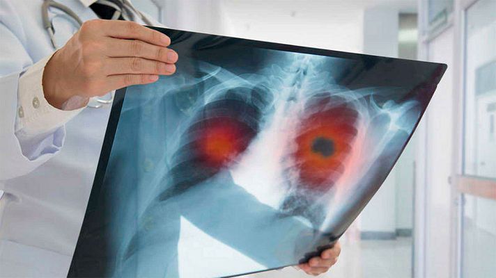 Telediario 1 - Los casos de cáncer suben un 12% en cuatro años y más del doble en mujeres