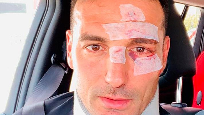 Telediario 1 - Lionel Scaloni recibe el alta tras sufrir un accidente en Mallorca