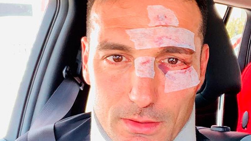 Lionel Scaloni recibe el alta tras sufrir un accidente en Mallorca | Ver