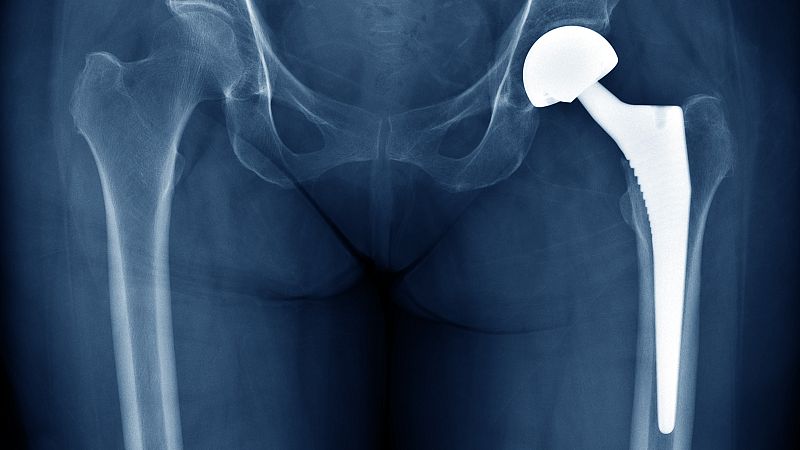 La Audiencia Nacional está investigando a la farmacéutica estadounidense Johnson & Johnson por comercializar presuntamente prótesis de cadera defectuosas que han sido implantadas en varios países, entre ellos España, donde hay 1.471 afectados. Las pr