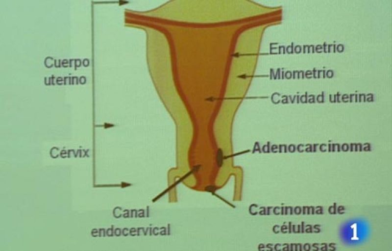 Ya está en marcha una nueva vacuna contra el virus del papiloma humano - Ciencia y tecnología en Rtve.es | Ver
