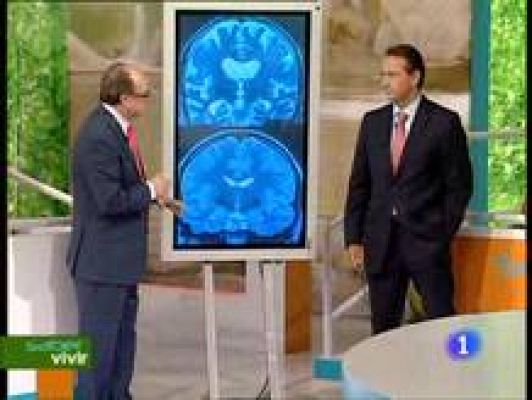  - Infartos en el cerebro