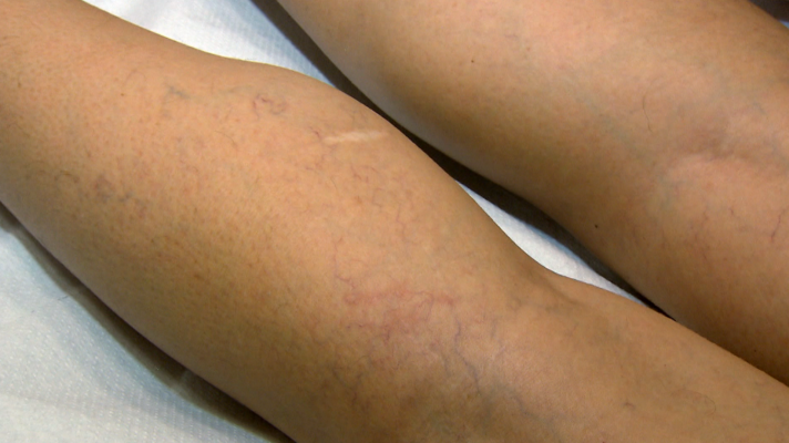 Saber vivir - Cómo prevenir las varices