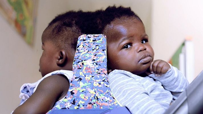 Telediario 1 - Separan con éxito a dos siamesas unidas por la cabeza