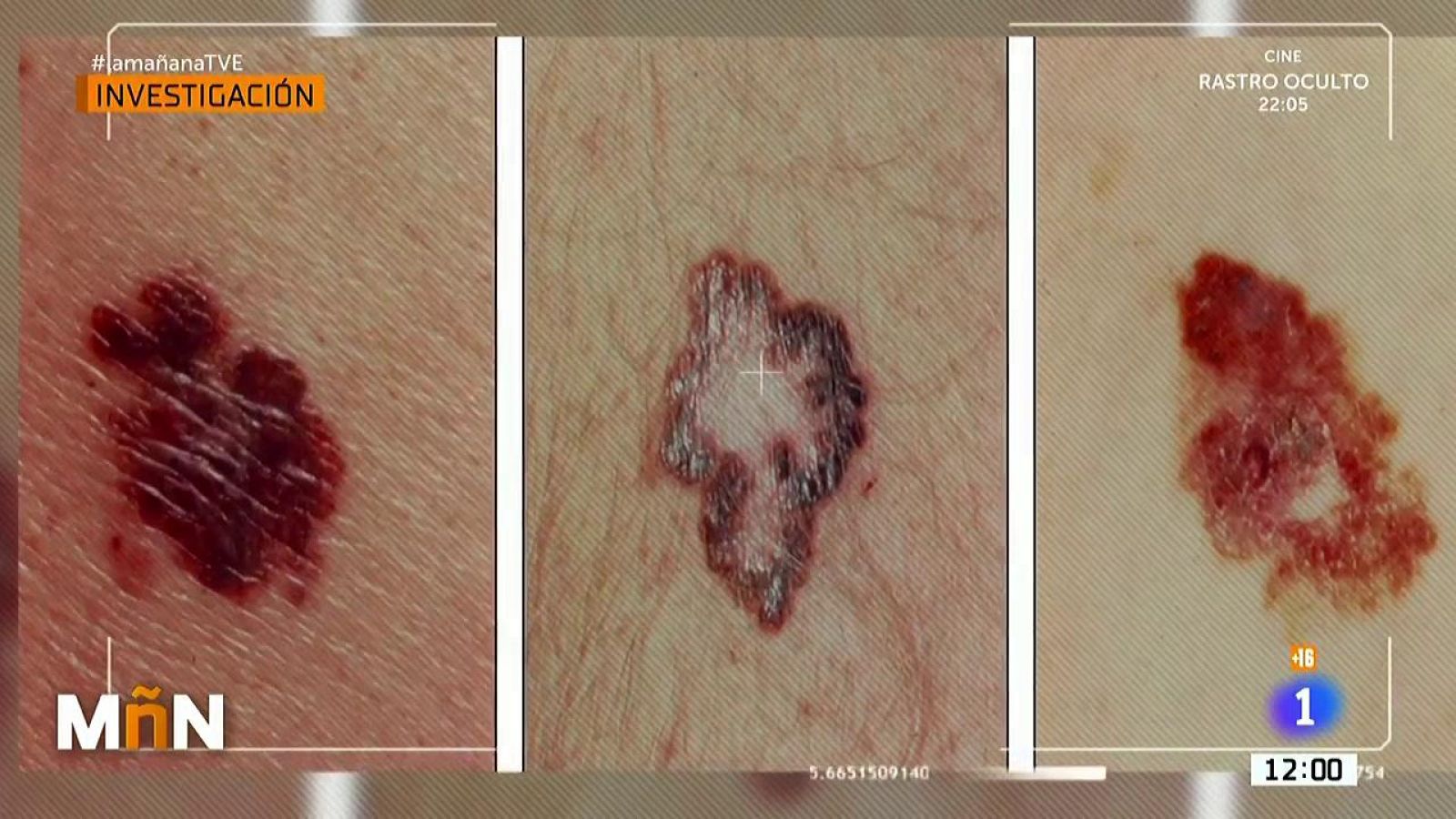 Los daños en la piel por el confinamiento, la mascarilla o el gel hidroalcohólico