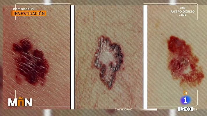 La mañana - Los daños en la piel por el confinamiento y la mascarilla