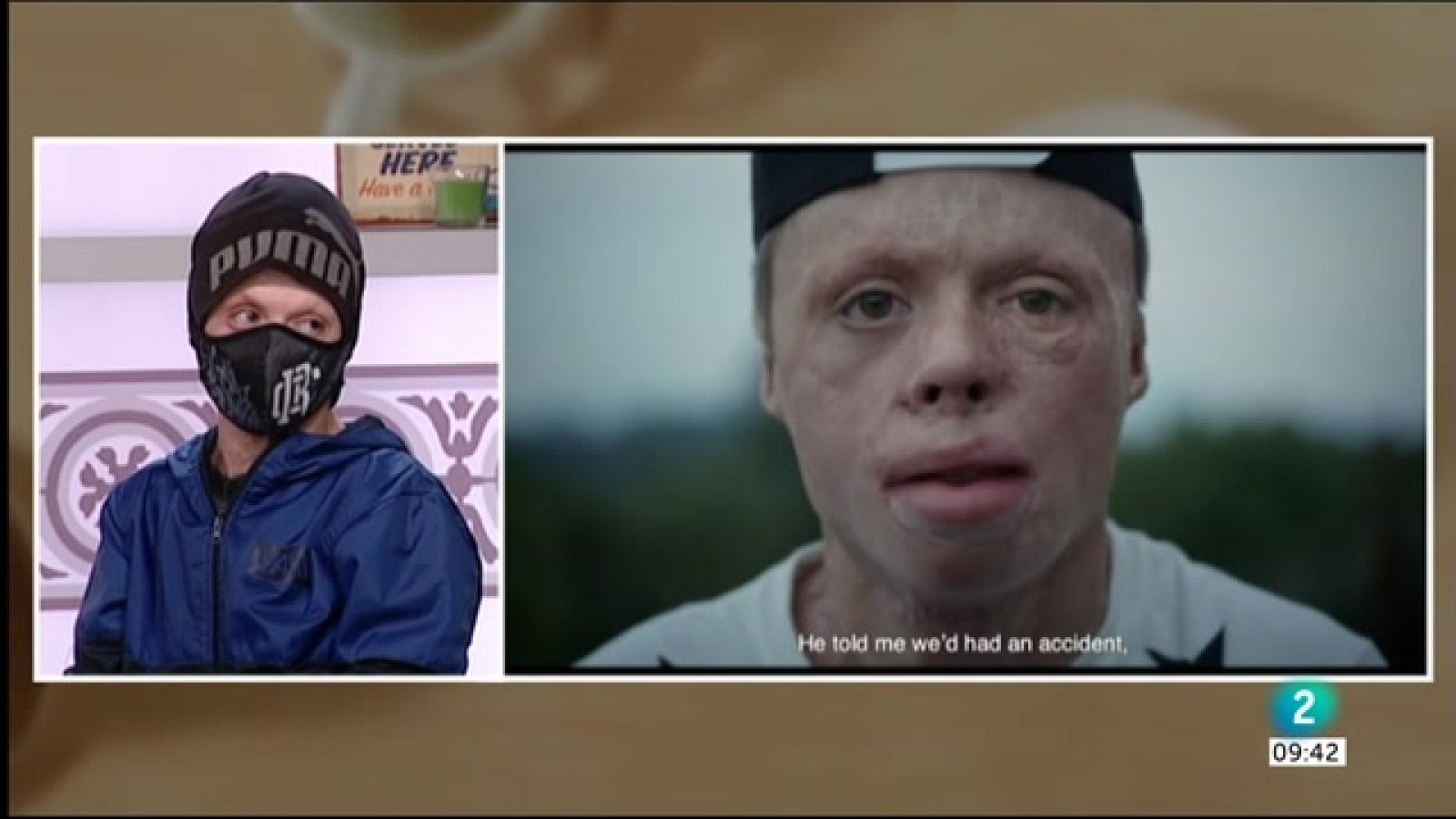 Descobrim la història de 'El niño de fuego', un supervivent amb el 90% del cos cremat