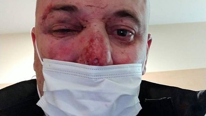 El cuñado de los agredidos en Linares: "Va a perder visión. Está mal. Igual que mi sobrina" - La hora de La 1 | Ver