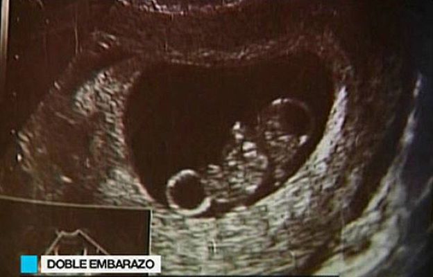 Ciencia y tecnología en Rtve.es - Se queda embarazada dos veces