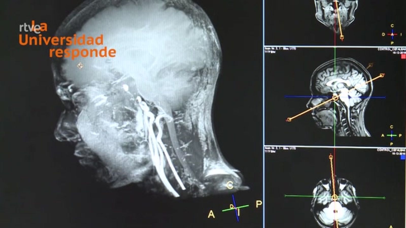 La aventura del saber - ¿Es peligroso hacerse una resonancia magnética? - ver ahora