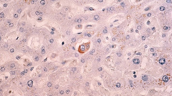 L'Informatiu - Avenç per frenar la progressió del càncer de mama: un fàrmac obre la porta a reduir la metàstasi