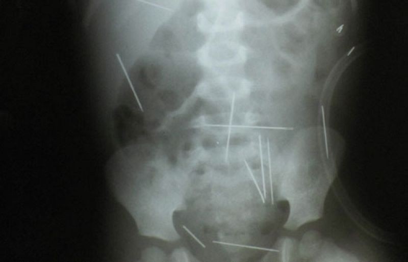Un niño de dos años tiene cerca de cincuenta agujas dentro del cuerpo | Ver