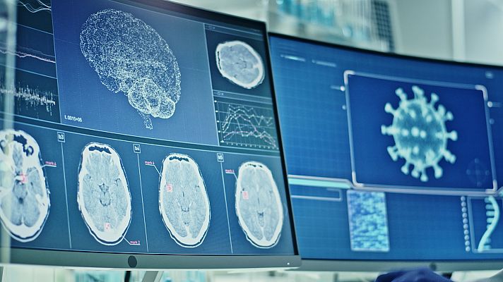 Telediario 1 - El COVID-19 grave puede envejecer el cerebro