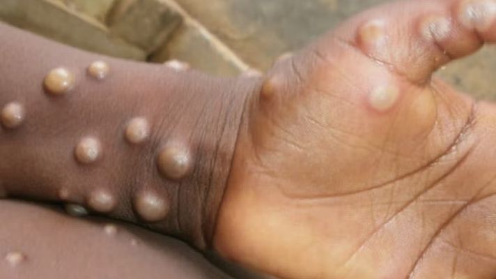 Telediario 1 - Detectan en Madrid ocho posibles casos de viruela del mono