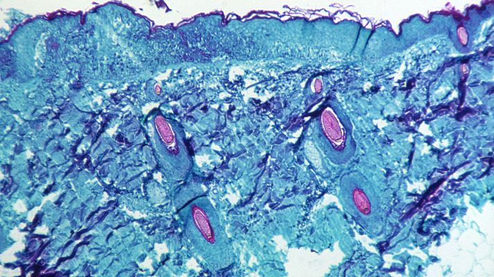 Telediario 1 - La vacuna tradicional, una aliada contra la viruela del mono