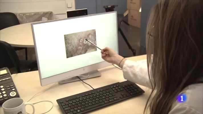 Telediario Fin de Semana - Viruela del mono: no se transmite por aerosoles