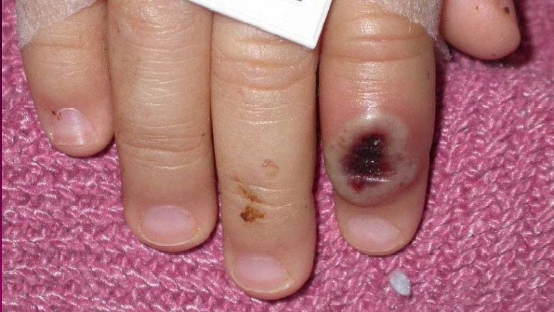 Canarias confirma el primer contagiado por viruela del mono | Ver