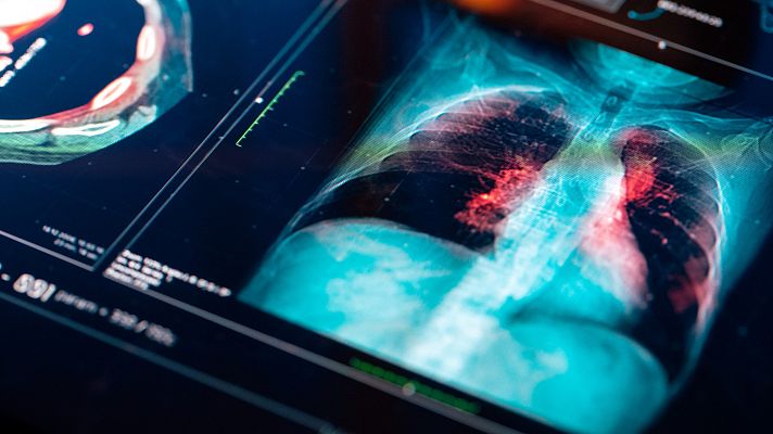Telediario 1 - Desarrollan una terapia que erradica uno de cada tres tumores en cáncer de pulmón precoz